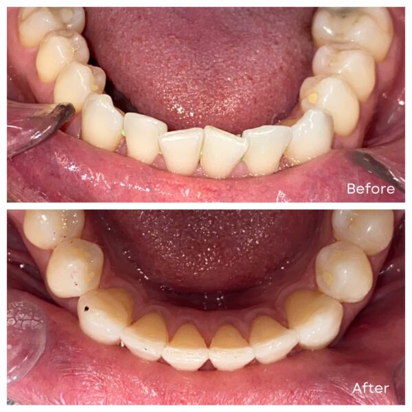 before and after Invisalign treatment in Arlington VA