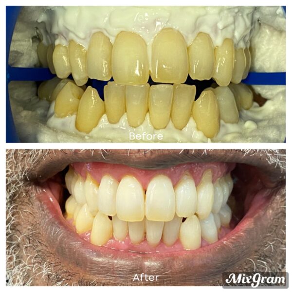 professional teeth whitening Arlington VA