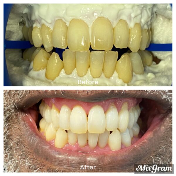Teeth-Whitening-Before-and-After-600x600